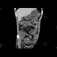 Crohn's disease, aboral ileum, enterography: CT - Computed tomography
